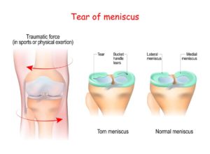 diagram of a torn meniscus