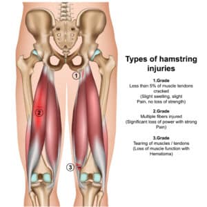 diagram showing the types of hamstring injuries