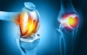 illustration of a knee with a prosthetic joint after knee replacement