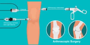 diagram of arthroscopic knee surgery