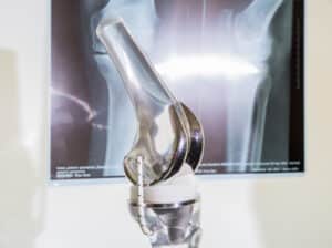 knee replacement