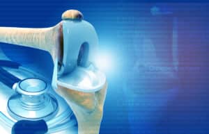 knee replacement