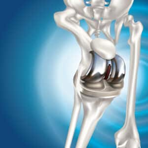 revision knee surgery