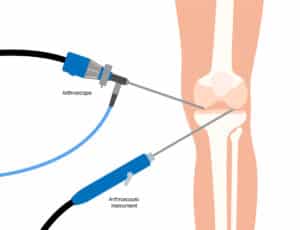 arthroscopic knee surgery diagram